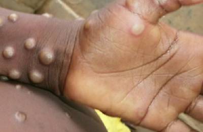 ΗΠΑ: Ένας 26χρονος που κόλλησε την ευλογιά των πιθήκων αφηγείται την εμπειρία του, λέγοντας πως ήταν «οι χειρότεροι πόνοι» που έχει νιώσει στη ζωή του