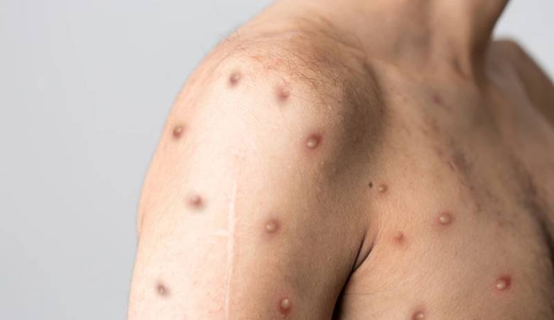 Ευλογιά των πιθήκων: Στα 54 τα κρούσματα στην Ελλάδα