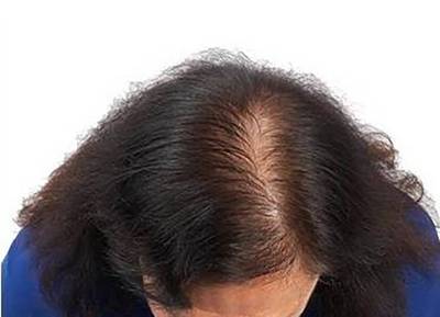 ΕΟΦ: Προσοχή σε ηλεκτρονικό κατάστημα με προϊόντα κατά της τριχόπτωσης τα οποία δεν έχουν ελεγχθεί