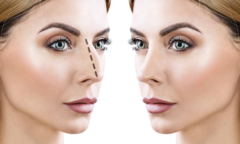 Ρινοπλαστική: Ανώδυνη και οριστική αποκατάσταση!