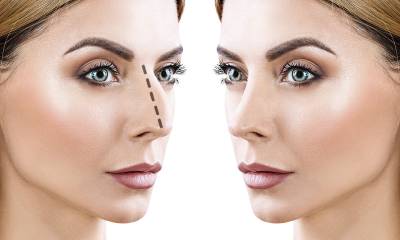 Ρινοπλαστική: Ανώδυνη και οριστική αποκατάσταση!