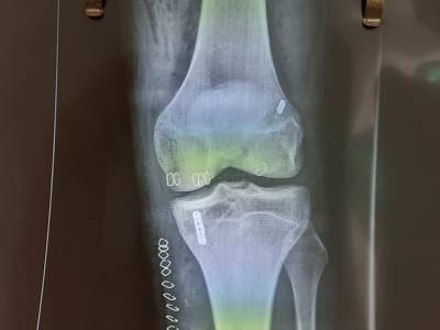 Αρθροσκοπική συνδεσμοπλαστική για πρώτη φορά στο Νοσοκομείο Κυπαρισσίας