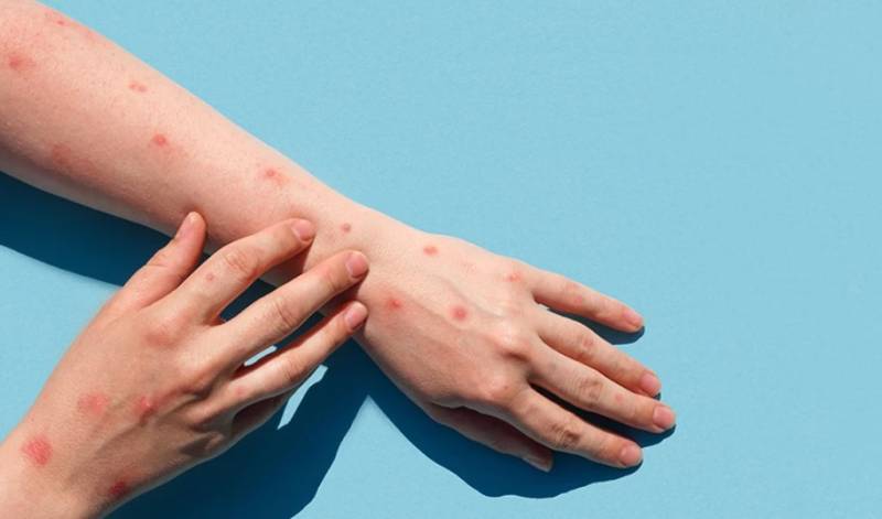 Ευλογιά των πιθήκων: 9 επιβεβαιωμένα κρούσματα σε μια εβδομάδα - Στα 48 ανέρχονται πλέον οι περιπτώσεις