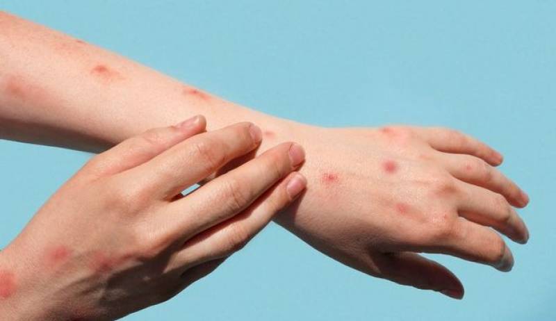 Ευλογιά των πιθήκων: Μόλις 1 στα 3 κρούσματα είναι εισαγόμενο (βίντεο)