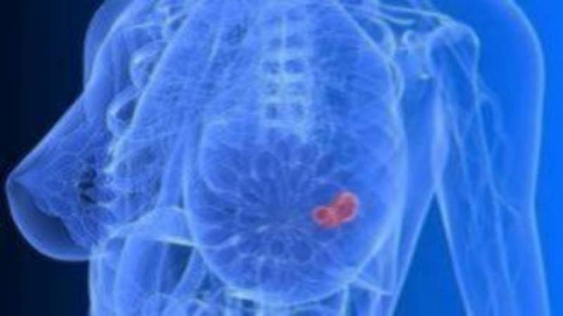 Κάθε χρόνο 4.500 γυναίκες στην Ελλάδα προσβάλλονται από καρκίνο του μαστού