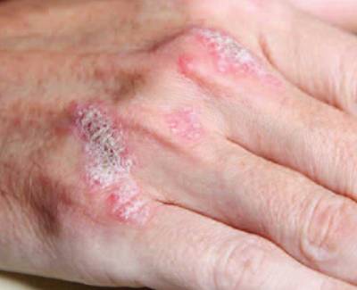 Η Ψωρίαση σήμερα (φωτογραφίες)