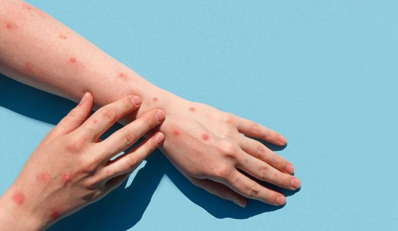 Ευλογιά των πιθήκων: «Εξαιρετικά σημαντική η ενημέρωση – Τεκμηριωμένος κίνδυνος για περαιτέρω μετάδοση»