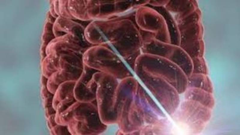 Εξέταση αίματος ανιχνεύει με 83% ακρίβεια τον καρκίνο του παχέος εντέρου