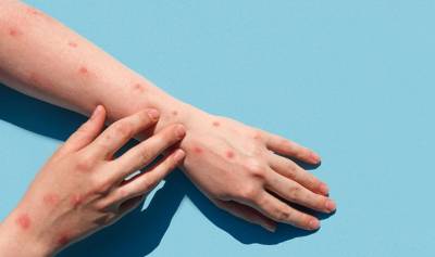 Τουρκία: Πρώτο κρούσμα ευλογιάς πιθήκων σε 37χρονο άνδρα