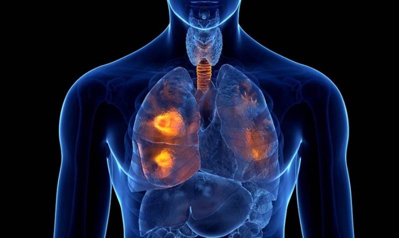 Καρκίνος του πνεύμονα: Κρίσιμος ο ετήσιος προσυμπτωματικός έλεγχος με αξονική